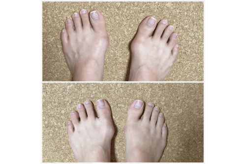 外反母趾の足と、意識的に足裏を使い外反母趾が引っ込む足の写真